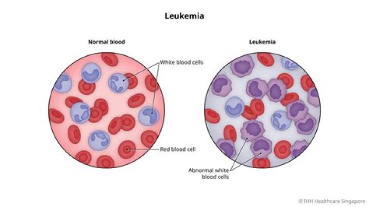 At what age does leukemia occur?