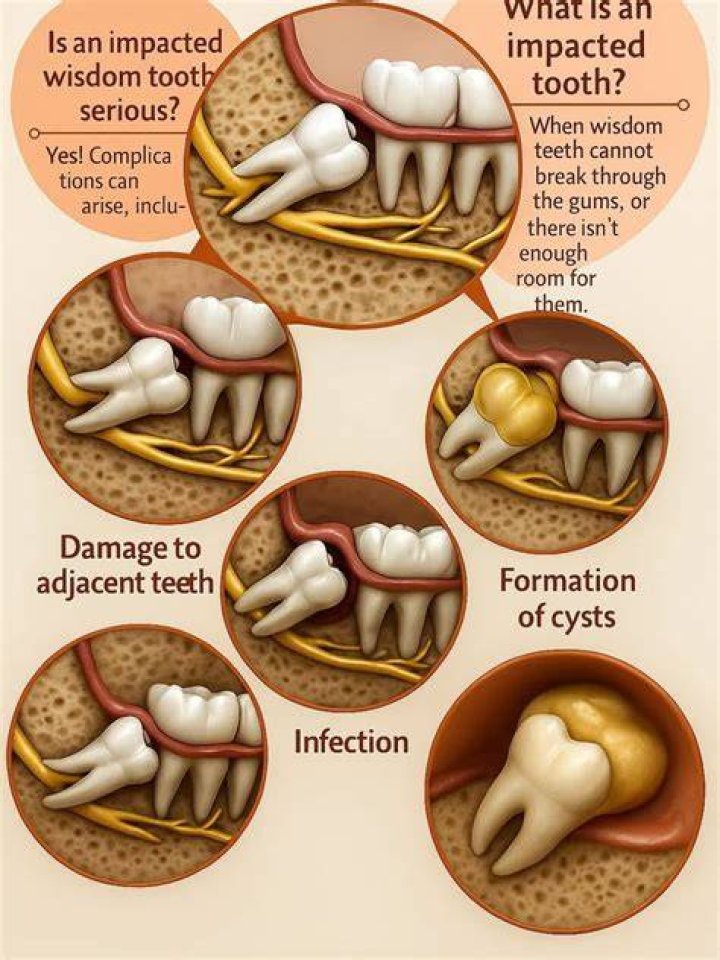 Can impacted wisdom teeth erupt?