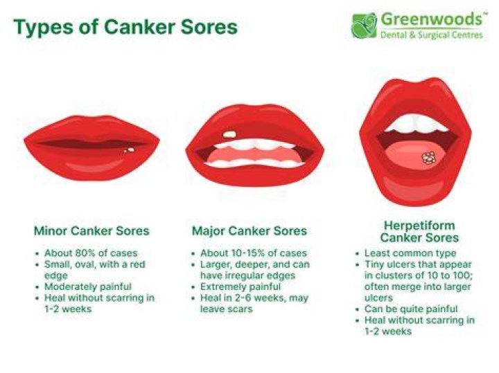 Do cankers always hurt?