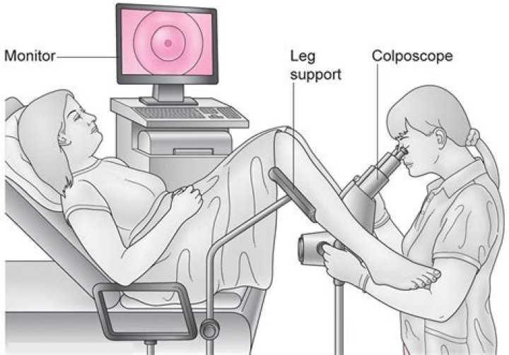 Do you always have a biopsy with a colposcopy?