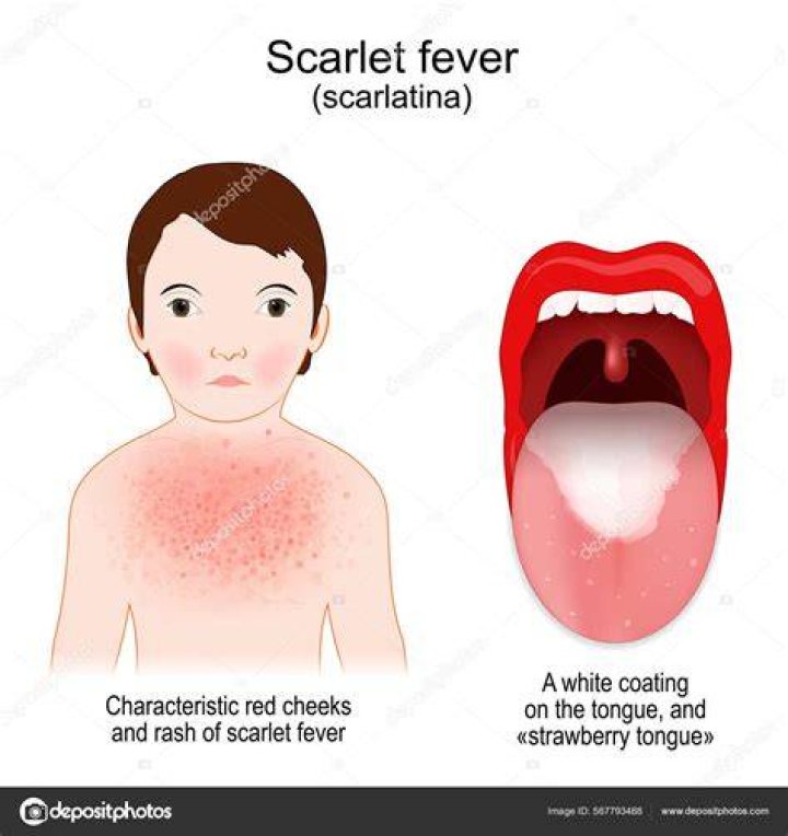 Does scarlatina go away?