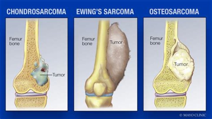 How fast do sarcomas grow?