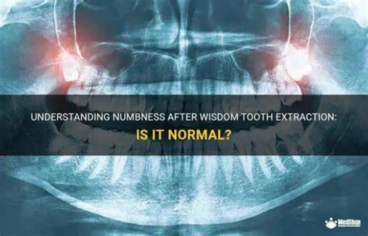 How long numbness after wisdom tooth extraction?