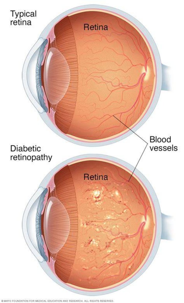 How retinopathy occurs in diabetes?