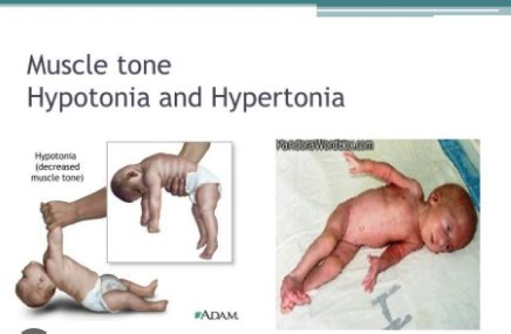 How to diagnose hypertonia in babies?
