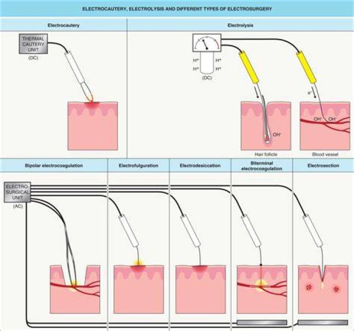 Is fulguration and electrocautery the same thing?