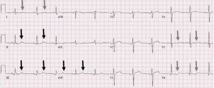 Should i worry about nonspecific t wave abnormality?
