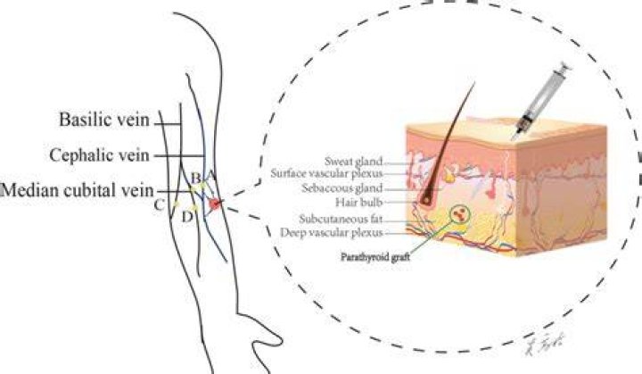What is parathyroid autotransplantation?