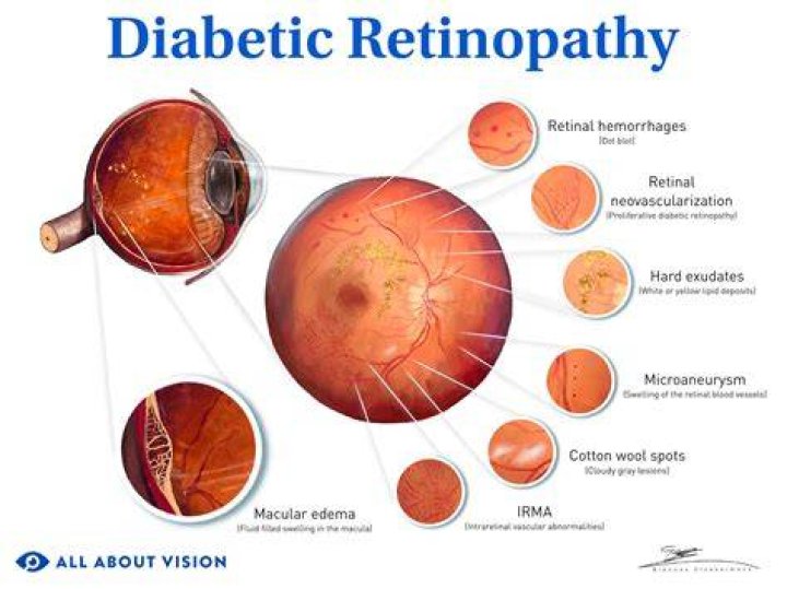 When to treat diabetic retinopathy?