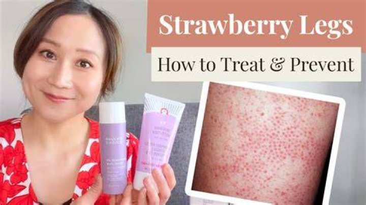 Will an epilator help with strawberry legs?