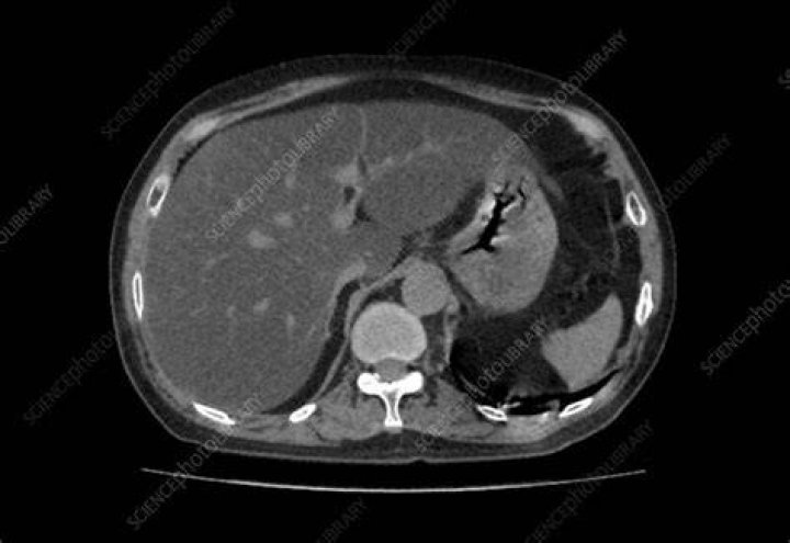 Would a ct scan show fatty liver?