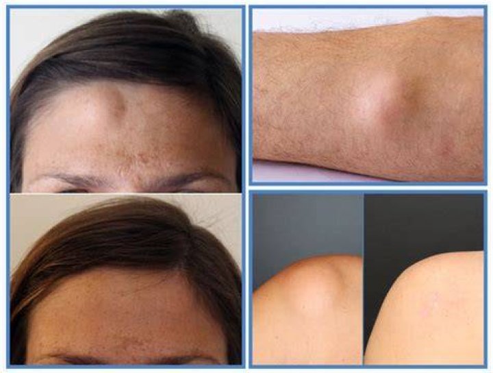 Would a dermatologist remove a lipoma?
